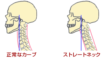 正常な首のカーブとストレートネックのイラスト