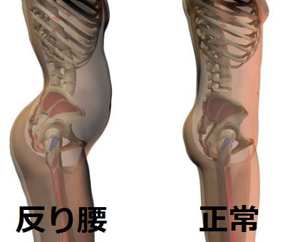 正常な骨盤と反り腰の骨盤のイラスト