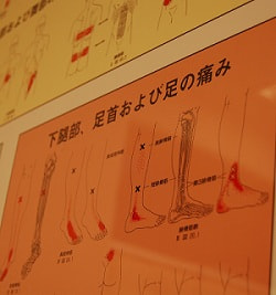 トリガーポイントの図解